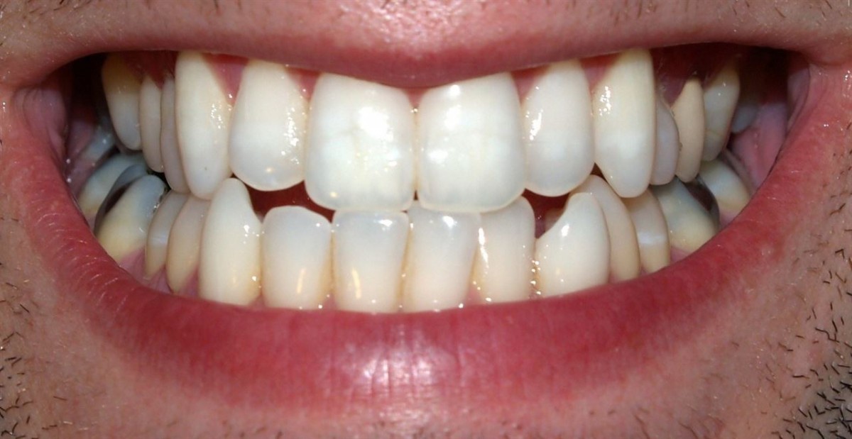 Halitosis