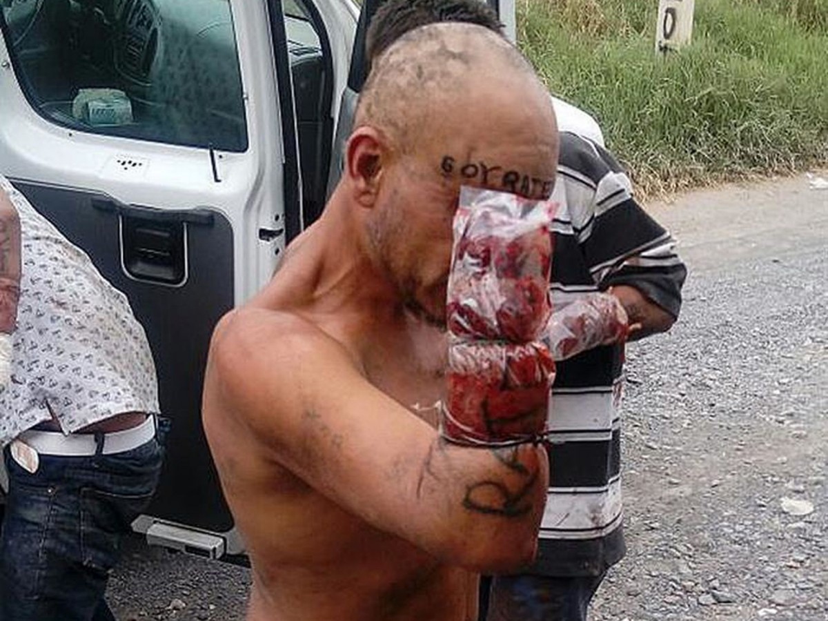 Una víctima muestra su amputación tras la agresión en Jalisco, México