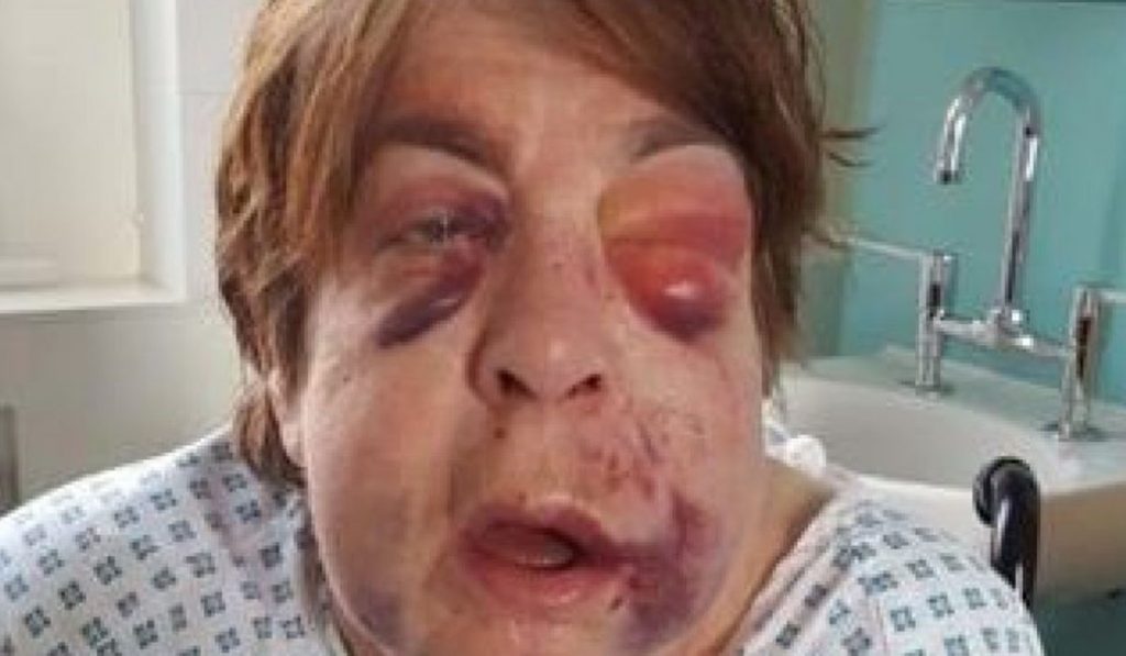 Barbara Dransfield tras la brutal paliza. METRO