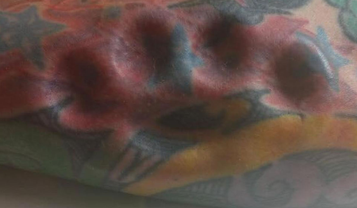 Podría perder el brazo después de que su cuerpo rechazara el implante de un puño americano. Facebook