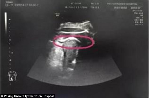 El Peking University Shenzhen Hospital ha compartido la fotografía en sus cuentas de redes sociales ayer. En el ultrasonido puede verse como el bebé de la señora Zhang tiene el pie fuera de la matriz después de patear su útero.