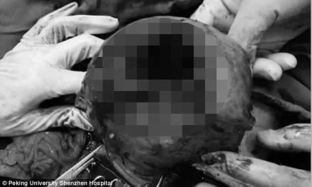La fotografía publicada por el Peking University Shenzhen Hospital, muestra a los doctores sujetando el útero roto de la señora Zhang.