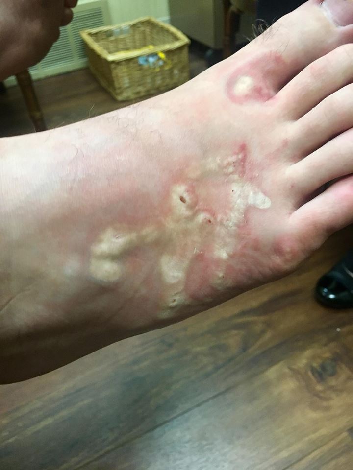 El pie de Michael, infectado con los parásitos. / FACEBOOK