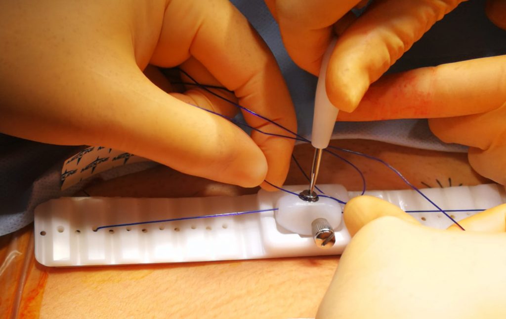 HUC NEOVAGINA DISPOSITIVO VAGINAL IMPLANTADO