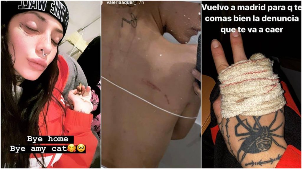 Valeria Quer ha mostrado las heridas que le ha provocado su exnovio a través de las redes sociales. El Español