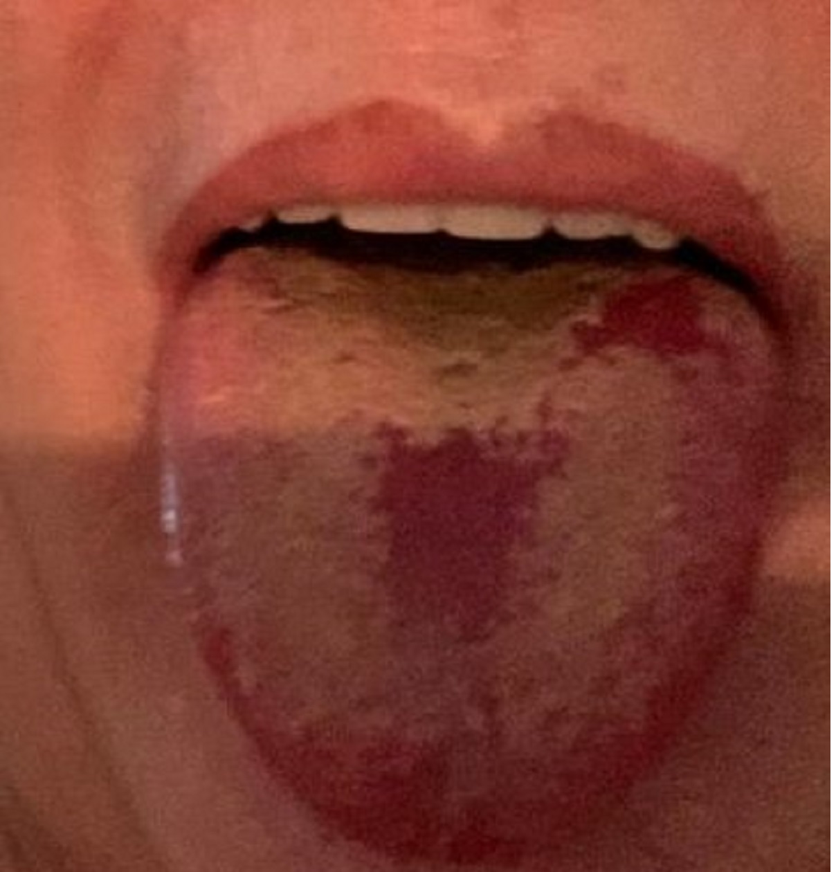 Un estudio revela que la 'lengua covid' es un síntoma del coronavirus