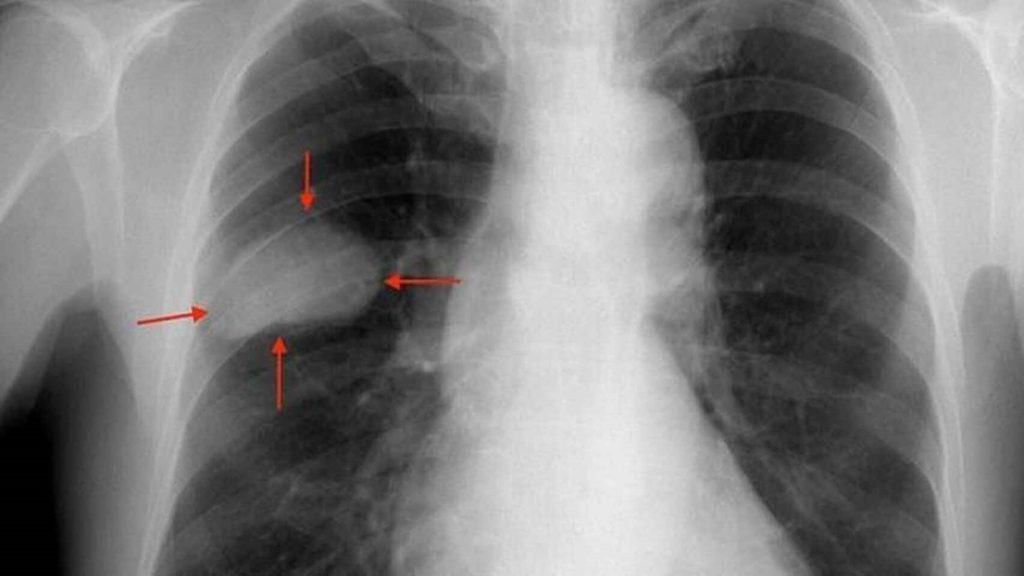 Una radiografía de los pulmones de un paciente con un tumor. Wikipedia