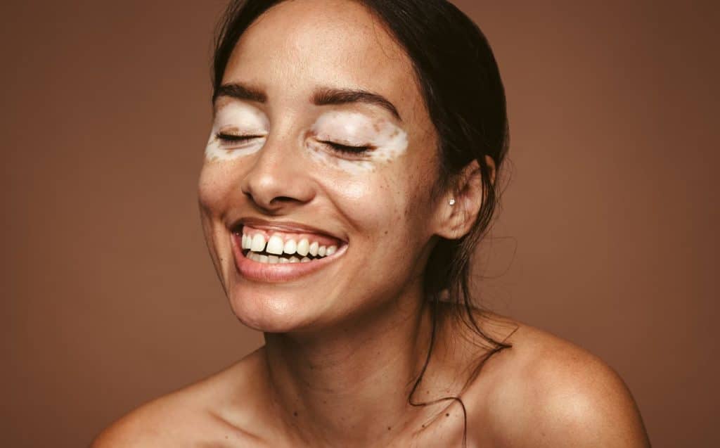Vitíligo: una crema puede recuperar hasta el 75% de las manchas en la cara