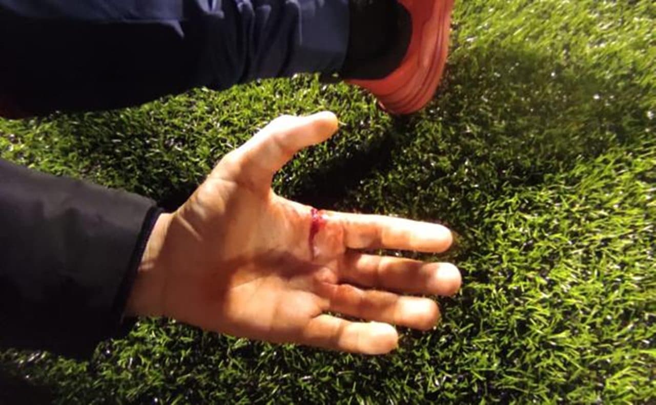 Dani Travieso sostiene que sufrió la herida al impedir que la navaja llegase al cuerpo del preparador físico de su equipo.