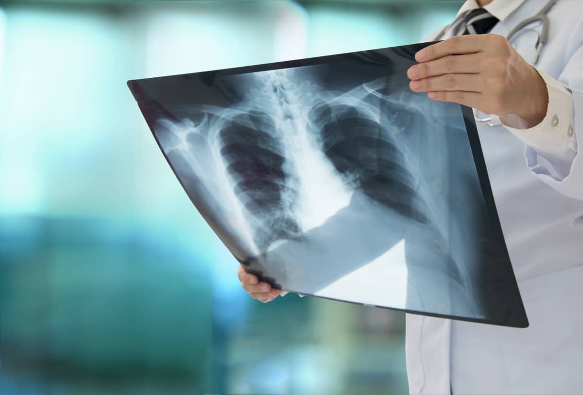 Hito contra el cáncer de pulmón: un fármaco reduce su mortalidad a la mitad