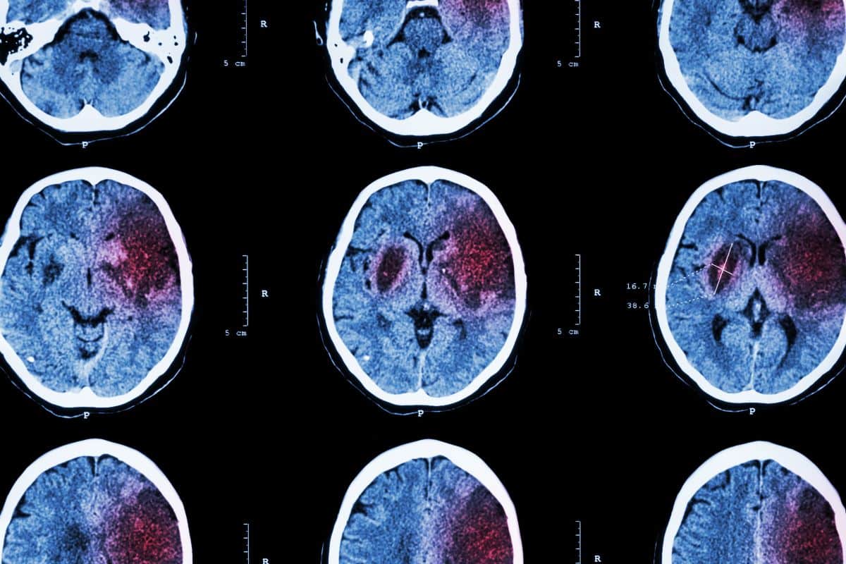 El ingrediente común que destroza el cerebro pero se toma a diario en España: la alerta de los médicos