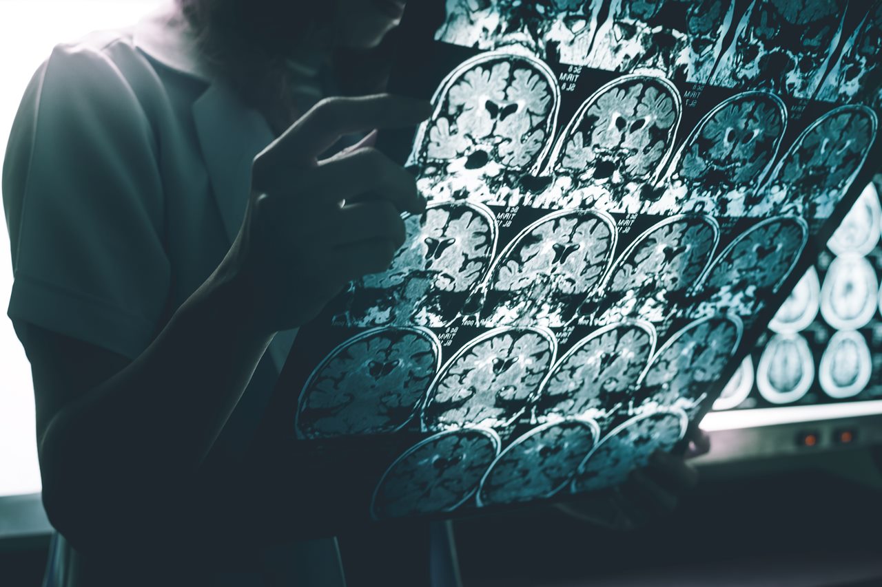 El estudio más reciente indica una posible relación entre dos patologías comunes y el Alzheimer