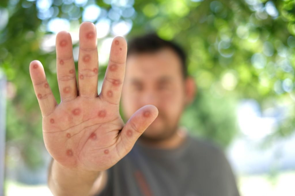 Estos son los viajeros que tendrán que vacunarse contra el mpox