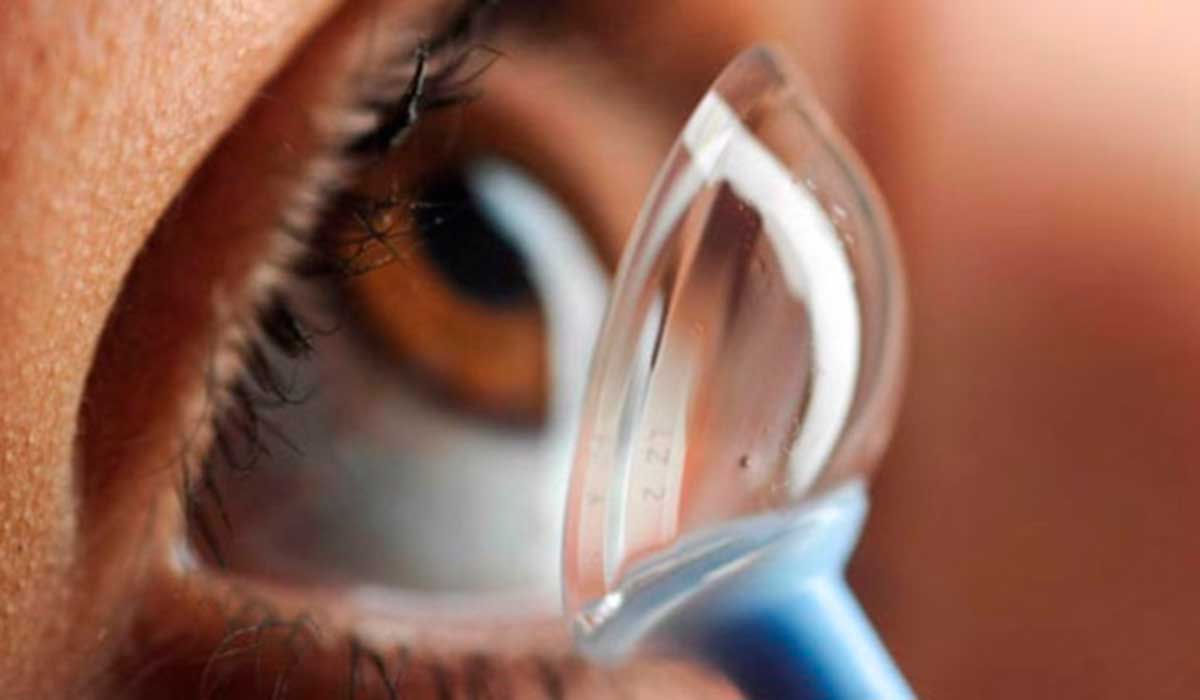 La revolución de las lentes de contacto esclerales contra el Queratocono