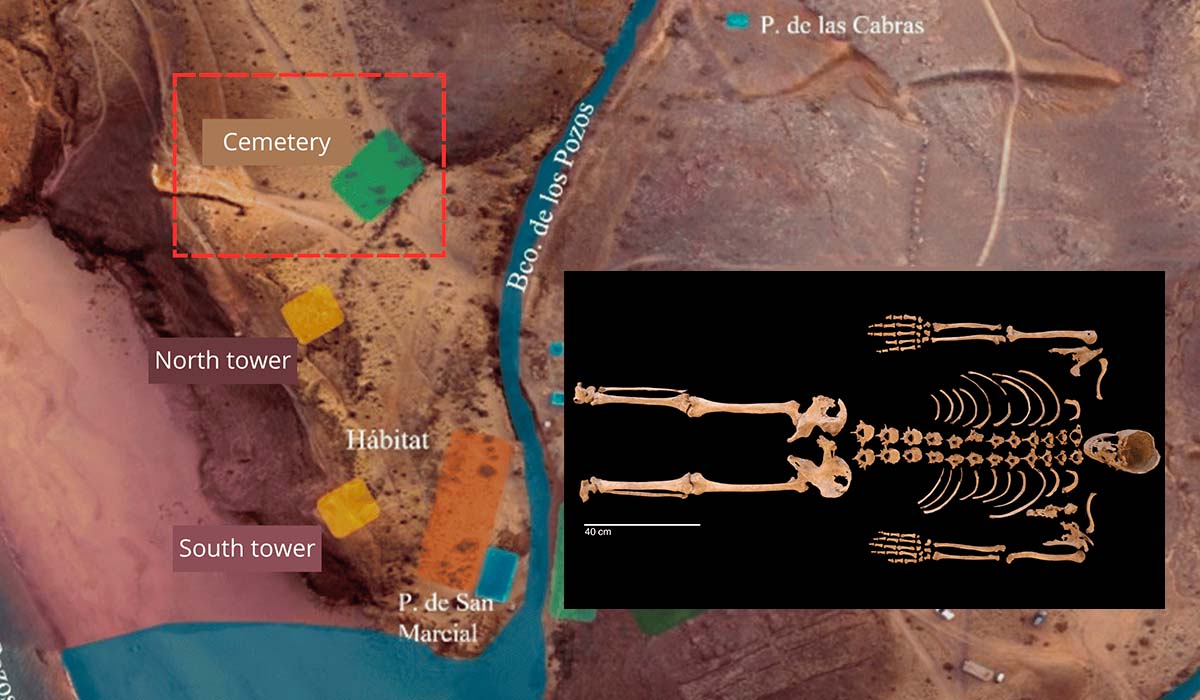 Un esqueleto de hace 600 años hallado en Lanzarote revela uno de los casos más antiguos de enfermedad de Paget